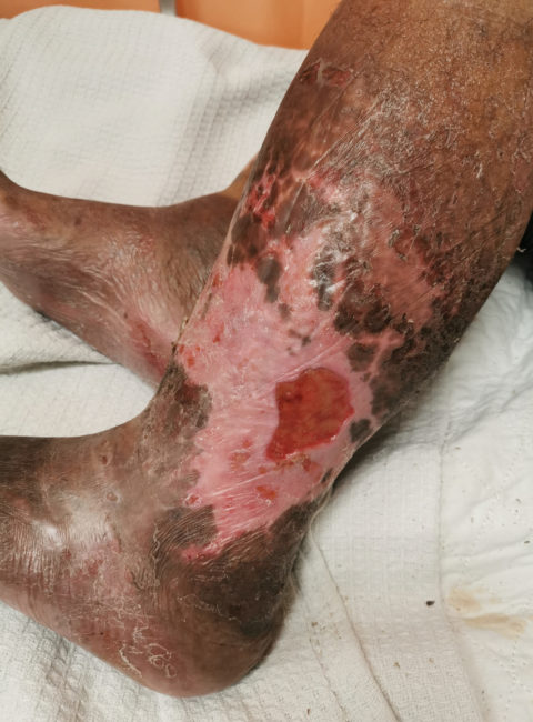 chronic venous insufficiency patient